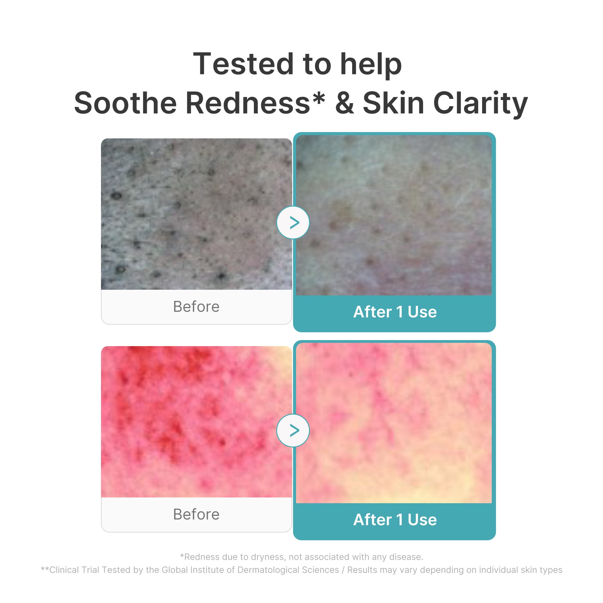 Azelaic Acid Capsule Foam Cleanser Y3