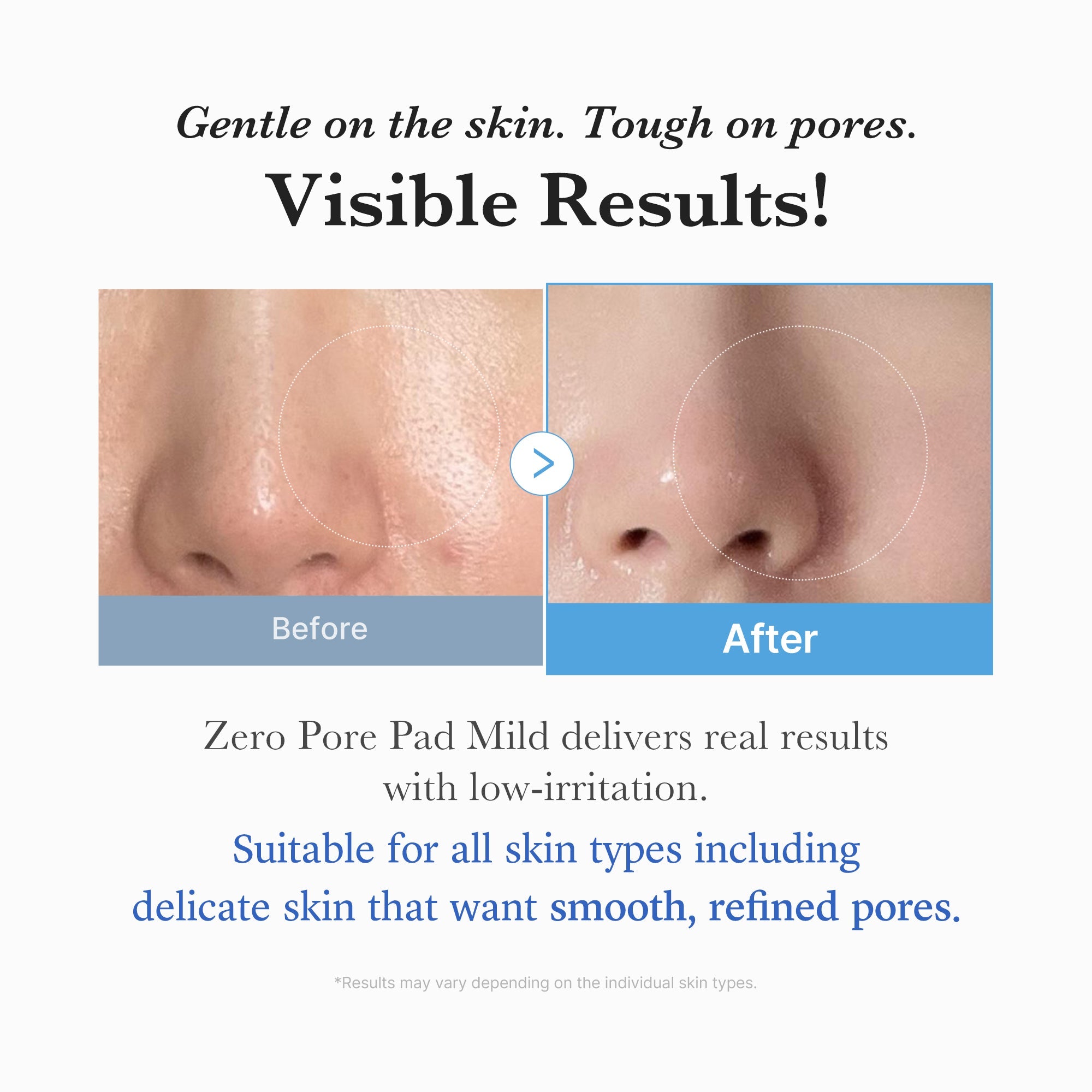 Zero Pore Madecassoside Pads (Mild) N2